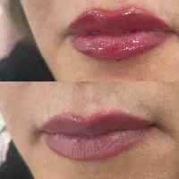 ژل و بوتاکس،مزوتراپی