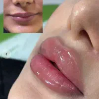 بوتاکس و فیلر