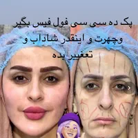 تزریق ژل لب بوتاکس زاویه سازی گونه فول فیس هایفو۲۴|خدمات آرایشگری و زیبایی|مشهد, احمدآباد|دیوار