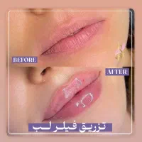 فیلر لب ۱/۶۰۰/تاپایان این هفته|خدمات آرایشگری و زیبایی|رشت, کوی حسینی|دیوار