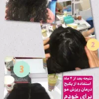 درمان ریزش مو خودتان را به ما بسپار|آرایشی، بهداشتی، درمانی|رشت, خواهر امام|دیوار