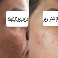 لیزرکیوسوییچ وایتینینگ پاکسازی هالیوودی سفید کننده|خدمات آرایشگری و زیبایی|اسلام‌شهر, زرافشان|دیوار