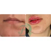 لیزر بوتاکس  ژل مزوتراپی توسط پزشک  در مسکن