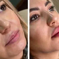 تزریق ژل و بوتاکس فقط ۵۰۰هزارتومان|خدمات آرایشگری و زیبایی|فولادشهر, B2|دیوار