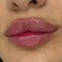 خدمات زیبایی فیلر ، بوتاکس ،مزوژل و