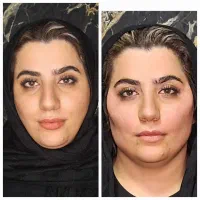 جوانسازی با تزریق چربی ،فیلر بوتاکس