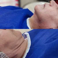 بلفاروپلاستی ساکشن غبغب|خدمات آرایشگری و زیبایی|اصفهان, مهدی آباد|دیوار