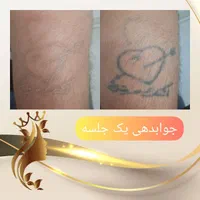 ریموو تتو با لیزر کیوسوئیچ و روشن سازی نواحی تیره|خدمات آرایشگری و زیبایی|قم, زنبیل آباد|دیوار