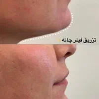 کلاژن مزوتراپی مزونیدلینگ|خدمات آرایشگری و زیبایی|مشهد, کوثر|دیوار