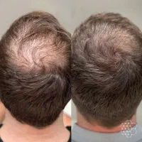 بدون جراحی ارگانیک موهات پر میکنیم|آرایشی، بهداشتی، درمانی|تهران, نیلوفر|دیوار