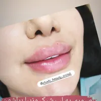 فیلر لب.بوتاکس.مزوژل.لب روسی.|خدمات آرایشگری و زیبایی|بندر انزلی, چهارفریضه|دیوار