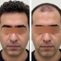 کاشت مو شیرازی vip فول تراکم تعرفه استثنایی