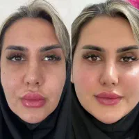 تخفیف کلینیک ژل بوتاکس نخ|خدمات آرایشگری و زیبایی|یاسوج, |دیوار