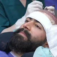 بلفاروبلاستی/کاشت مو/کاشت ابرو/کاشت ریش/عمل بینی