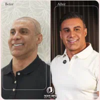 کاشت مو اقساطی کلینیک نوین ایرانا