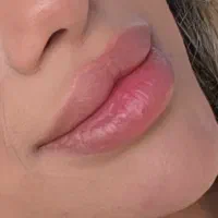 خدمات ژل و بوتاکس