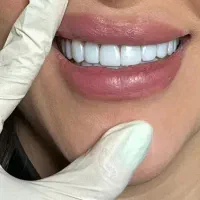 زیر قیمت بیمه،خدمات دندانپزشکی ۵۰٪ تخفیف حقیقی|خدمات زیبایی و سلامت|تهران, جمالزاده|دیوار