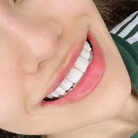 ایمپلنت ،اورتودنسی ، کامپوزیت ، عصب کشی در تبریز