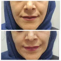تزریق ژل و بوتاکس، ژل لب روسی و آموزش و ارائه مدرک|خدمات آرایشگری و زیبایی|کرج, شاهین‌ویلا|دیوار
