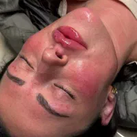 ژل و بوتاکس و آموزش حرفه ای