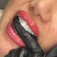 دنتال وست  کامپوزیت لبخند vip