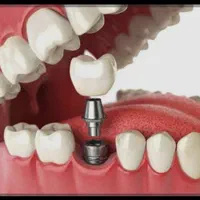 تخفیف ویژه بهترین برندهای ایمپلنت|خدمات آرایشگری و زیبایی|شیراز, زرگری|دیوار
