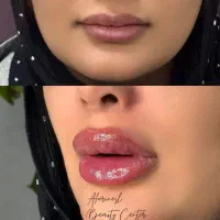 مدل جهت تزریق لب