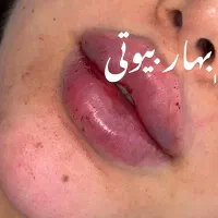 تخفیف خدمات تخصصی ژل بوتاکس مادلینگ مزوتراپی آنزیم|خدمات آرایشگری و زیبایی|کرمانشاه, |دیوار