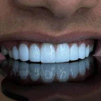 کامپوزیت اقساط/طراحی لبخند طبیعی جدیدترین متد