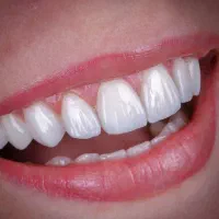 دندانپزشکی،کامپوزیت دندان،روکش دندان|خدمات آرایشگری و زیبایی|شیراز, شهرک ولیعصر|دیوار