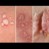 بهبود زگیل و تبخال با ضمانت