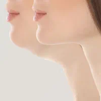 جراحی زیبایی بلفاروپلاستی بوکال فت غبغب