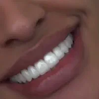 جشنواره کامپوزیت دندان|خدمات آرایشگری و زیبایی|کرج, کوی کارمندان شمالی|دیوار