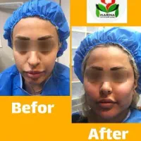 تزریق چربی کل صورت و دیپ هیپ پشت دست