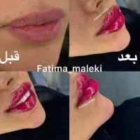 آفر ویژه آموزش حرفه ای فیلر و بوتاکس تا آخر هفته|خدمات آموزشی|تهران, هفت حوض|دیوار