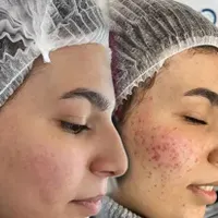 پاکسازی پوست صورت تخصصی (فیشیال vip)|خدمات آرایشگری و زیبایی|سنندج, |دیوار