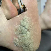 پدیکور درمانی به شیوه ی روسی و پدولوژی و زگیل پا