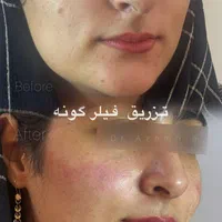 ژل ،بوتاکس لیزر مو رفع تتو پاکسازی هایفو توسط پزشک|خدمات آرایشگری و زیبایی|پرند, فاز ۲|دیوار