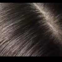 پایان کابوس شپش سر