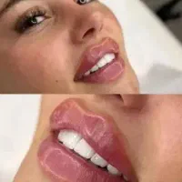 لیزر خانم آقا ژل بوتاکس هایفو لاغری امبدینگ|خدمات آرایشگری و زیبایی|سیرجان, |دیوار