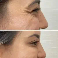 مدل بوتاکس رایگان شرایط رو نوشتم