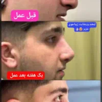 تخفیف لیپو ابدو ۱۱تومن رینوعمل بینی|خدمات آرایشگری و زیبایی|تهران, آهنگ|دیوار