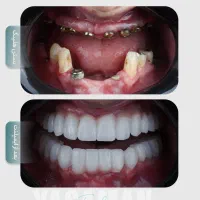 ایمپلنت تخصصی/لمینت/لیفت لثه/کامپوزیت