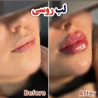 تخفیفات ژل و بوتاکس جوانساز توسط شخص دکترچابکی