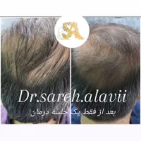 درمان ریزش مو توسط پزشک|خدمات آرایشگری و زیبایی|قم, دورشهر|دیوار