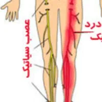 درمان‌ کامل .ضمانتی سیاتیک به روشTAHGS