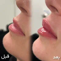 فیلر کل صورت