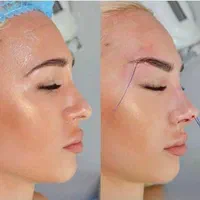 ژل وبوتاکس.افزایش سایزآلت آقا.لیفت بانخ توسط پزشک|خدمات آرایشگری و زیبایی|قم, صفائیه|دیوار