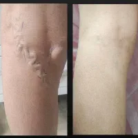 درمان تخصصی واریس