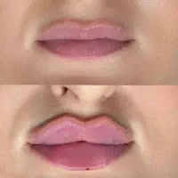 خدمات تخصصی فیلر،ژل،بوتاکس،نخ لیفت،مزو باقمیت عالی